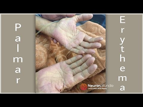 Palmar Erythema/reddish discoloration of the palm/How it looks? #med school #clinicalexamination