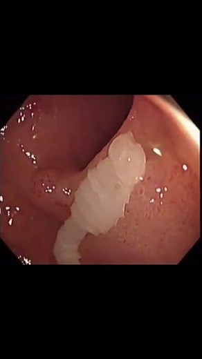5K views · 46 reactions | Fish Tapeworm infection found in colon #parasites #cleanse #science | Parasite Purger | Facebook