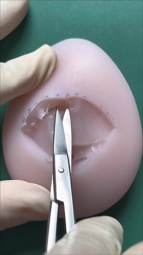 Skin-sparing mastectomy (part 2)