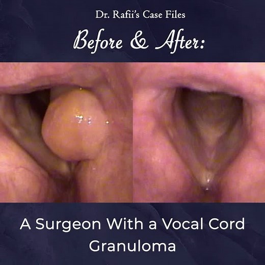 Voice before and after granuloma removal #voice #vocals #vocalcord #singer #voicecare