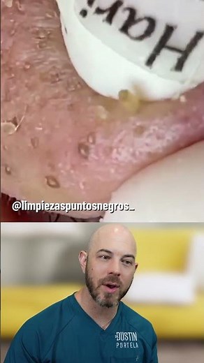 This Nose Won’t Heal Without Treatment — Rosacea Explained