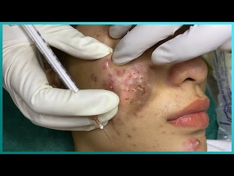 Big Cystic Acne Blackheads Extraction Blackheads & Milia, Whiteheads Removal Pimple Popping