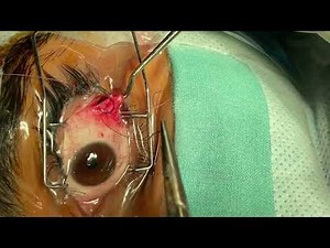 Lateral Rectus Recession