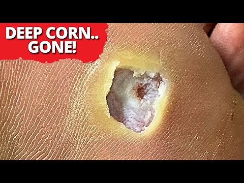 Removing a Deep, Blistered Corn – Satisfying Foot Transformation!
