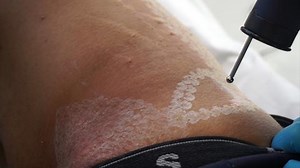 Erbium Laser for Stretch Marks