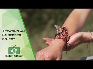 Treating an Embedded object on the First Aid Show