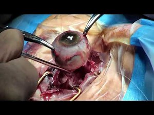Eye Enucleation using a snare