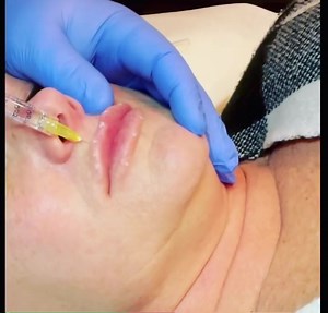 Dr Ziad Sara a Master injector utilizes cutting-edge injectable techniques for his patients. Let the results speak for itself! Call 859-554-0519 to schedule your appointment. | Advanced Skin & Vein Care Centers