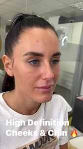 1.6K views | High Definition Cheeks & Chin Treatment! Natural and subtle  #cheekaugmentation #ogeecurve #zygomaticbone #cheekfiller #cheekinjections #cheekcontouring #cheekcontour #cannulatechnique #cheekfillersuk #cheekfillerspecialist #cheekvolumisation #contouredcheeks | Million Dollar Face | Facebook