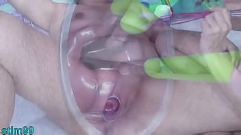 Hot Lesbians get prolapse cervix with catheters inserted into their uterus