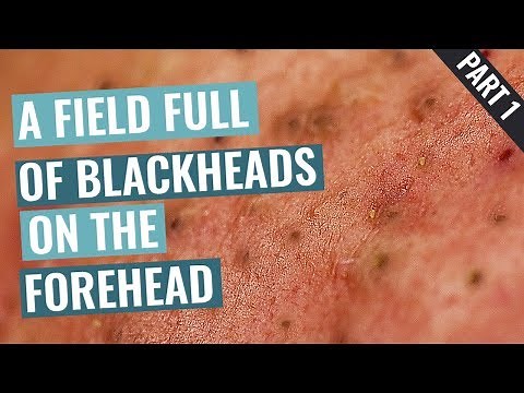 A Field Full of Blackheads on Aimilios’s Forehead - Part 1 out of 4