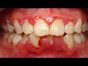 3 Easy Ways to Get Rid Of Gum Swelling | How to Get Rid Of Swollen Gums | Natural Remedies
