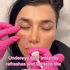 Do you have tired looking eyes? 💉👀 Looking to brighten up your tear troughs? 🌟 🔸 Undereye filler is a great way to address this and give you a youthful looking appearance! 💕 For this procedure, I prefer to use a cannula to inject the filler because utilizing a blunt tip does not pierce the skin. ❤️ The cannula method effectively minimizes the risk of accidentally puncturing a blood vessel. ✨ Benefits of using a cannula: 💖 allows for more accuracy to achieve the desired results 💖 less risk