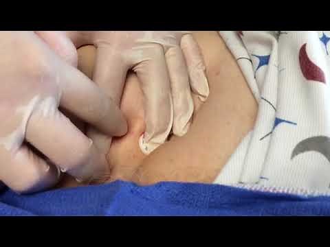 StatSeal Advanced Disc arterial & venous sheath removal
