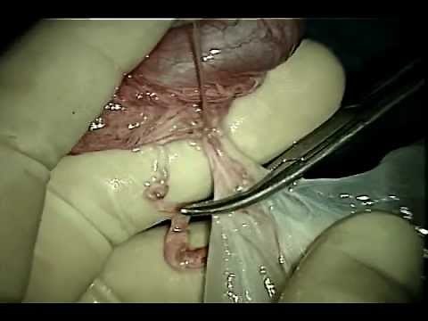 Dr. Marc Goldstein: Microsurgical Management of Spermatocele