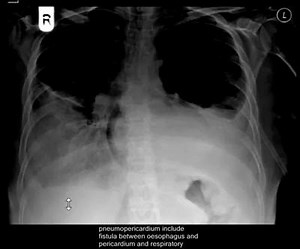 Pneumopericardium--CXR | Cardiology-Dr.AsifUllah