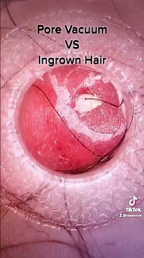 Pore vacuum sucks out huge ingrown hair oddly satisfying and gross
