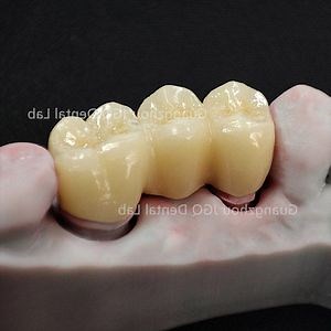 [Hot Item] Personalized Customization Full Zirconia Dentures with Color-Matched to Natural Teeth and High Strength