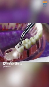 Simplify pulp devitalization with Waldent Devital Pulp Gel! :...