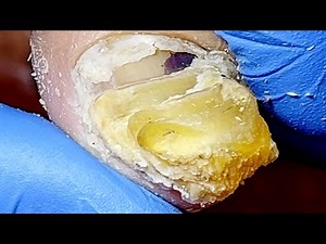 The Onychomycosis Spreads Outwards And A Large Protrusion【Podiatry Clinic】