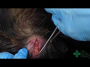 Removal of a Large Pilar Cyst
