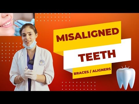 Braces for crooked teeth, transformation before & after #braces #orthodontist #dentist #bracket