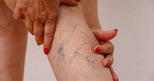 Ter veias saltadas é normal? Saiba quando se preocupar