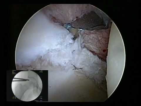 Hip Labral Repair