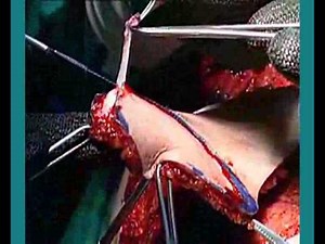 Ftm SRS Gender Reassignment Surgery Perovic Total Phalloplasty