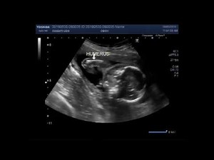 Ultrasound Video showing a case of club foot, also called talipes equinovarus (TEV).