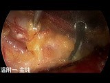 Dual-port Trans-subclavian Thyroid Endoscopic Surgery (Part 4) • Video • MEDtube.net