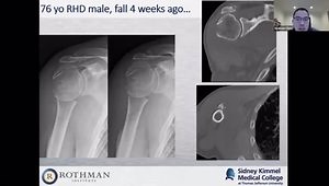 Proximal Humerus Fractures: Fix It or Replace It?