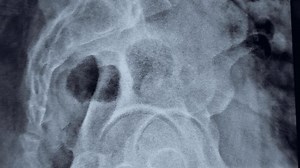 X-ray Lumbosacral Spine Shows Straightening Lumbar Stock Footage Video (100% Royalty-free) 3700476265 | Shutterstock