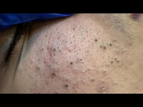 Deep Cleansing Techniques For Acne — Severe Acne Removal