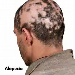 1K views · 24 reactions | Hundreds of symptoms have been associated with gluten-related disorders. These are but a few of the many possible you might experience as an adult with celiac disease. Learn more here https://gluten.org/2019/10/15/could-gluten-be-causing-your-health-problems/ | Gluten Intolerance Group | Facebook