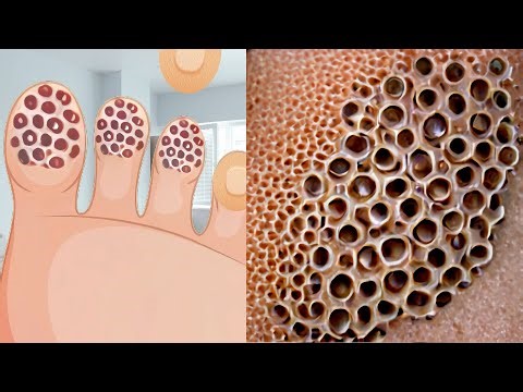 ASMR Animation Treatment Foot Maggot Removal | Deep Cleaning Animation