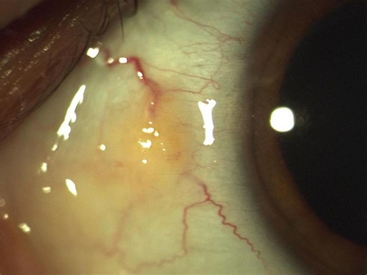 Is This Growth on My Eye a Pinguecula?