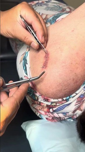 how to remove surgical sutures - continuous sutures.