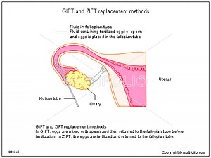 علاجات GIFT و ZIFT للعقم - العقم والإنجاب 2025