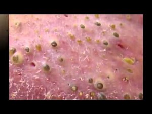 0:00 / 1:30 Comedone Extracted! Zits, Acne, Cysts, Blackheads and Pics