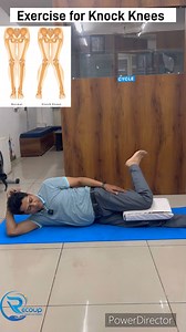 54 reactions | Exercise for knock knee. Knock knee correction Exercise. #knockknee #knockkneecorrection #knockkneesexercises #knockkneeproblems | Drsunil Baghel Physio | Facebook