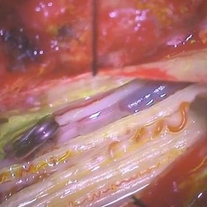Spinal dural arteriovenous fistulas (#dAVF) are a heterogeneous group...