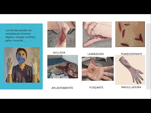 Curación de heridas