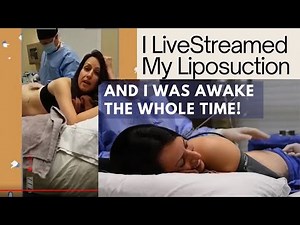 Watch Laser Liposuction LIVE and AWAKE with Dr. Mitchell Chasin of Reflections Center in New Jersey