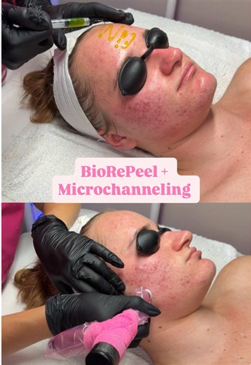 Client's Cystic Acne Transformation with BioRePeel