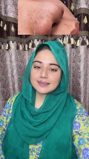 Blackheads Remove Remedy with Vaseline | Clean Pores Instantly