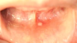 Disease in the mouth. Stomatitis into mouth on the lower lip. Close-up
