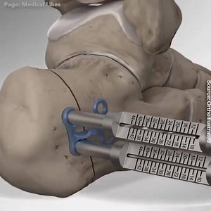 Amazing Flatfoot Repair Procedure | Medical & Health