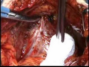 Radical Retropubic Prostatectomy