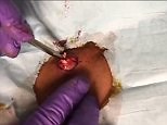 Large gruesome cyst being popped at the base of neck